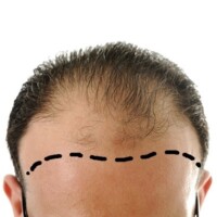 Injerto de pelo Implante capilar Barranquilla