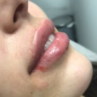 Aumento de labios relleno de labios barranquilla