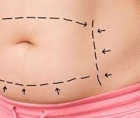 Abdominoplastia Abdominoplastia Barranquilla