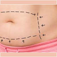 Abdominoplastia Abdominoplastia Barranquilla