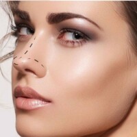 Rinoplastia Rinoplastia Barranquilla